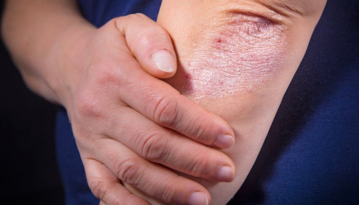 Artritis Psoriásica