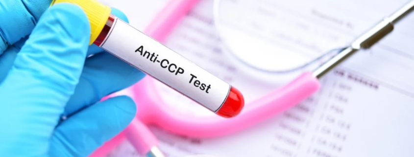 Los Anti CCP son exclusivos de la Artritis Reumatoide